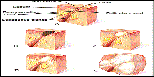 Causes of Acne