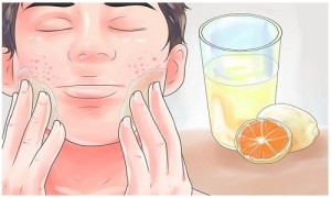 How Can Acne Scars Be Removed